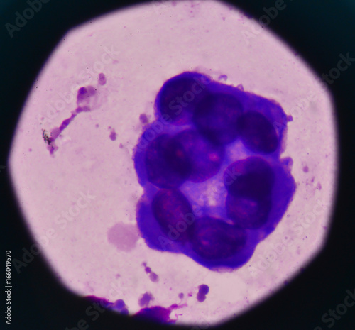 Abnormal malignant cells specimen pleural fluid. photo