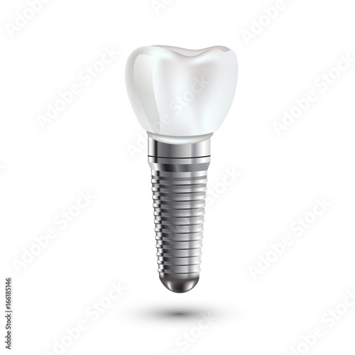 Dental implant realistic anatomy illustration.