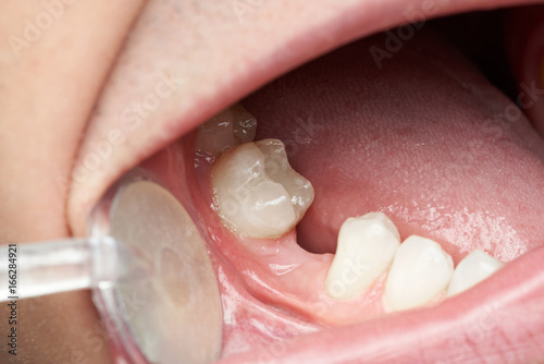Fototapeta Naklejka Na Ścianę i Meble -  Missing tooth space in mouth