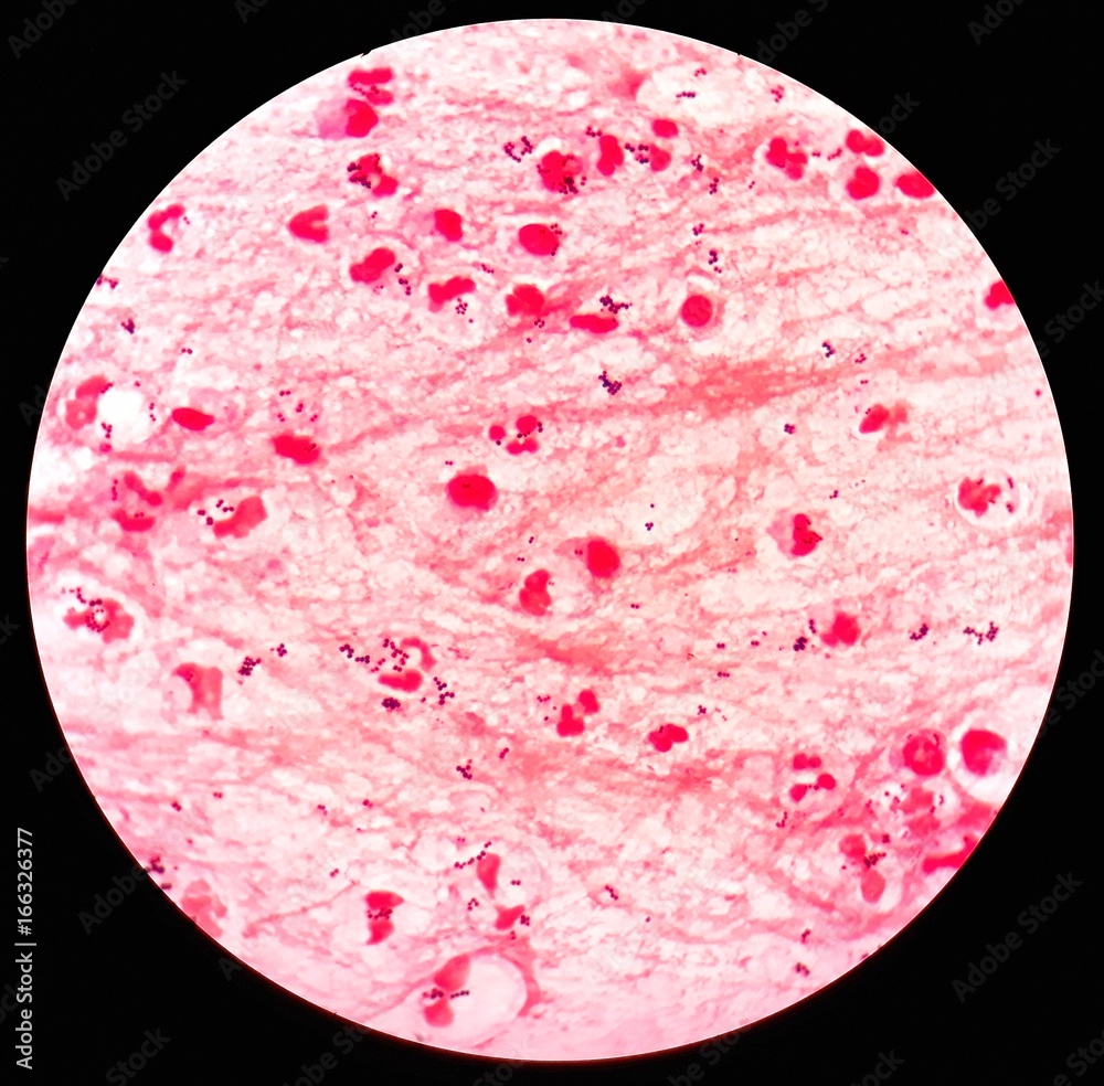 Smear of sputum specimen Gram's stained under 100X light microscope