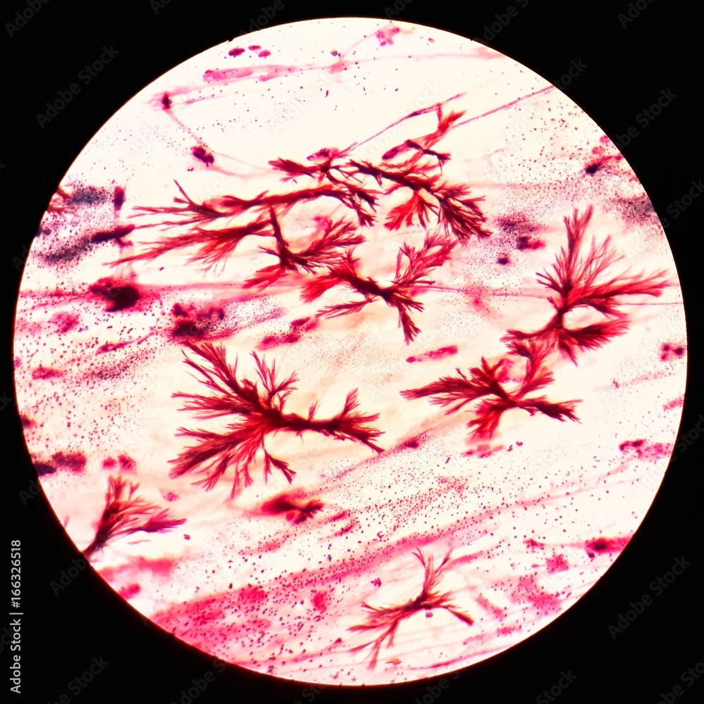 Smear of sputum specimen Gram's stained under 100X light microscope ...
