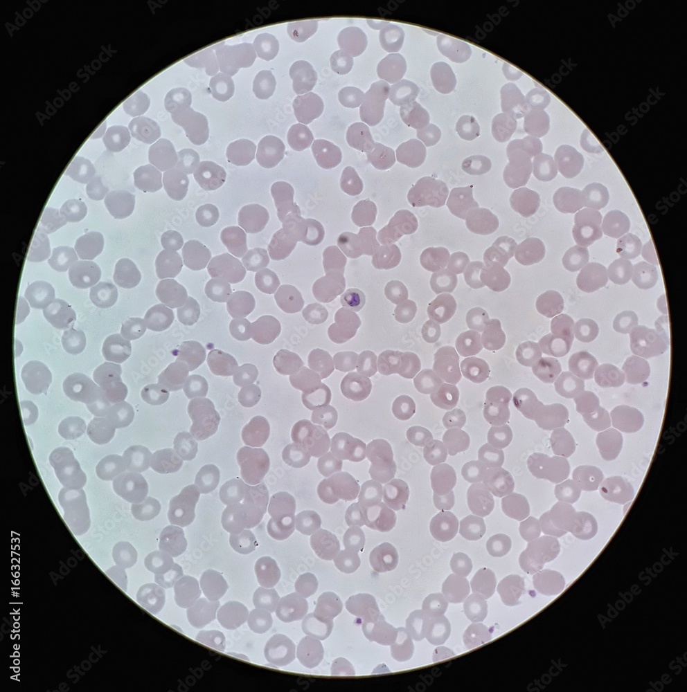 Under X Light Microscope Human Parasite On Thin Film Of Blood Smear With Plasmodium Malariae