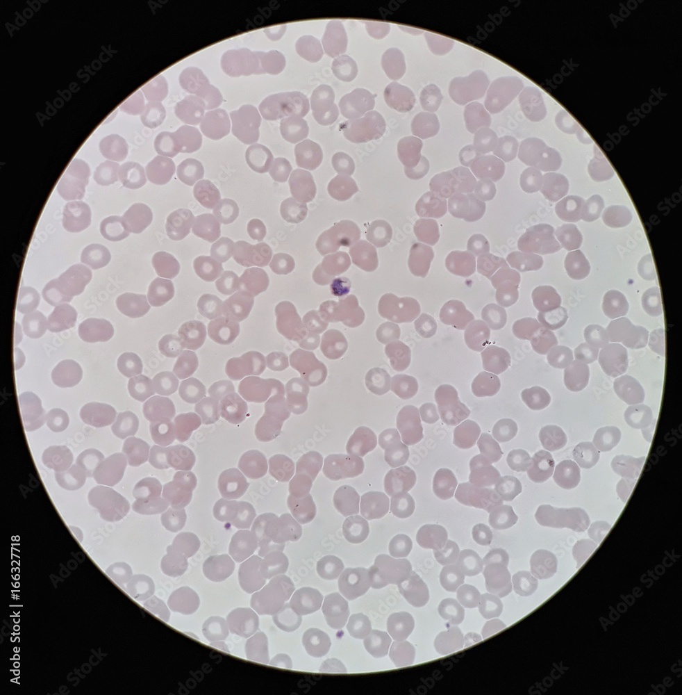 Under 100X light microscope, human parasite on thin film of blood smear with Plasmodium malariae trophozoite form malaria infected red blood cell, selective focus. Under 100X light microscope, human parasite on thin film of blood smear with Plasmodium malariae trophozoite form malaria infected red blood cell, selective focus.