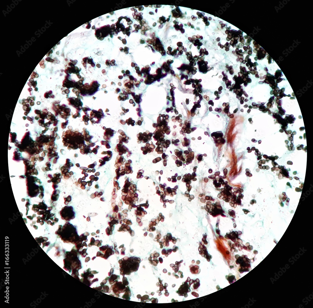 Smear from tissue biopsy Giemsa stained under 100X light microscope with  positive Penicillium marneffei, a dimorphic fungus which is a pathogen  cause "Penicilliosis" and endemic in Southeast Asia. Stock Photo | Adobe