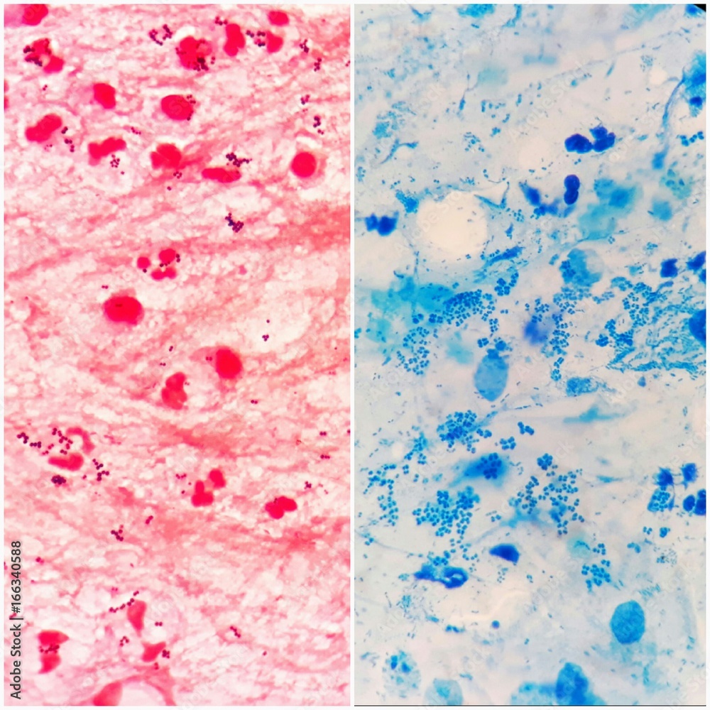 Two smear patterns of gram positive cocci bacteria in sputum specimen