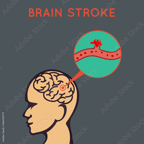 Brain stroke vector illustrator