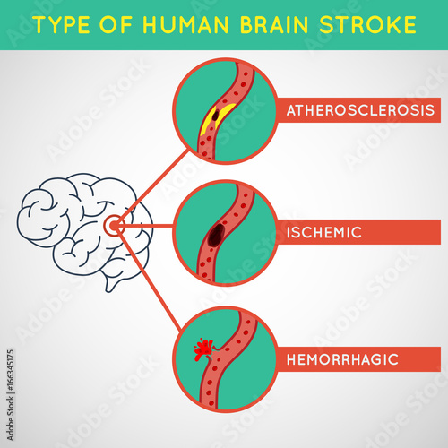 Brain stroke vector illustrator