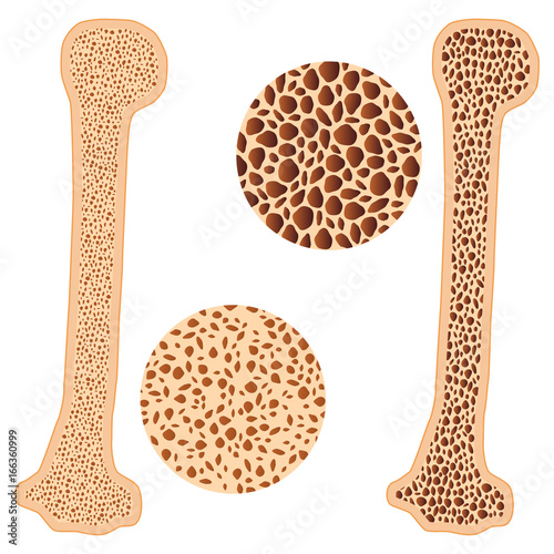 Osteoporosis bone and healthy bone.