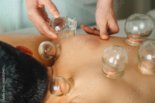 glass cupping therapy