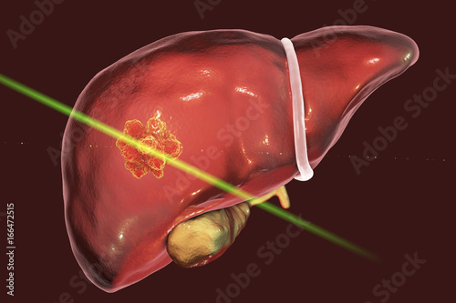 Εκτύπωση καμβά Liver cancer treatment with laser