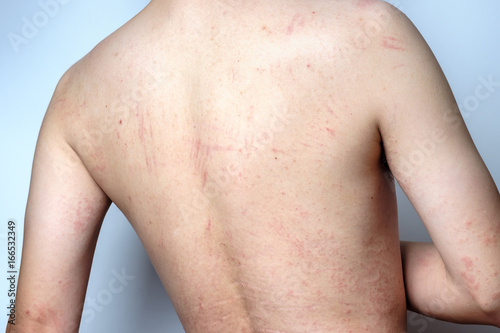 Man with dermatitis problem of rash