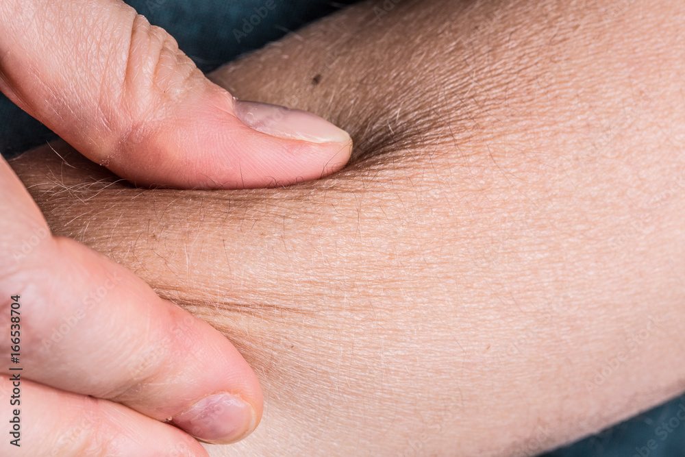 Fingers tightening the wrinkled skin of the arm Stock Photo | Adobe Stock