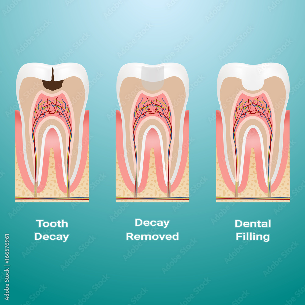 Treatment Of Caries. Dental Filling. Dental Caries Detailed Isolated On A Background. Vector Illustration. Stomatology. Teeth And Tooth Concept Of Dental