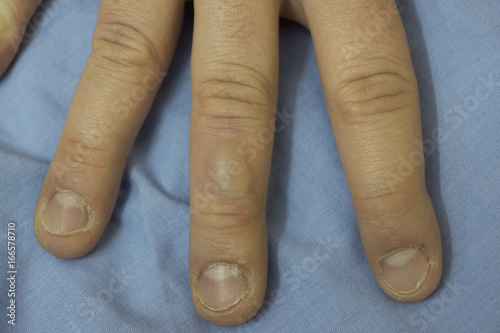 Blister on a finger (first-degree burn)