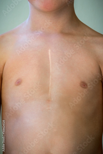 Front view of young caucasian boy with healed surgical scar after heart surgery.