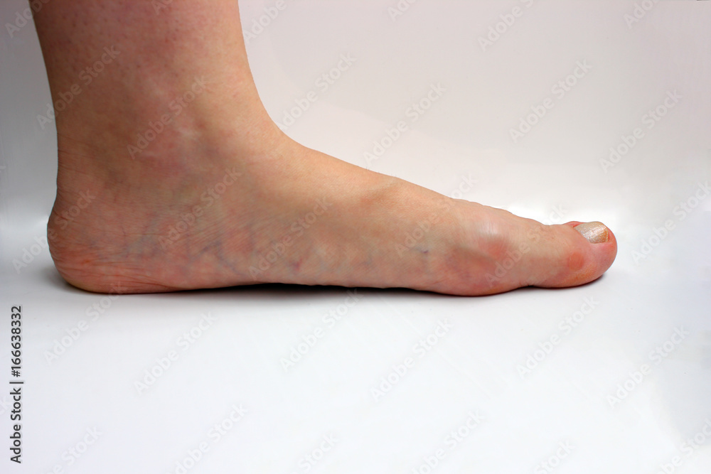 Medicine, flat feet, tarsoptosia, foot female isolated on white background, as a manual for the textbook Medicine, flat feet, tarsoptosia, foot female isolated on white background, as a manual for the textbook