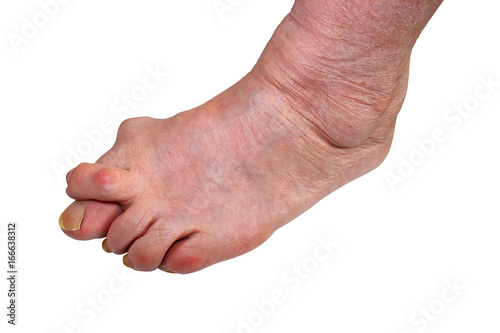 Medetcin, valgus bunion, leg with deformity valgus hallux (Bunion), the consequence of refusal of treatment, space for text