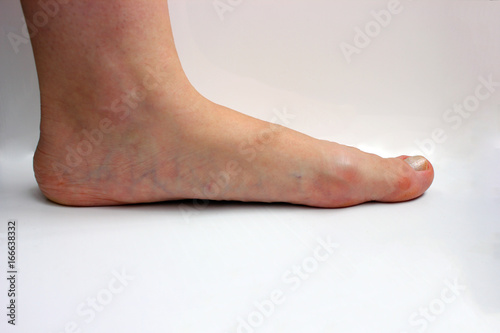 Medicine, flat feet, tarsoptosia,  foot female isolated on white background, as a manual for the textbook © игорь перекрестоd
