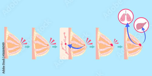 cartoon breast cancer