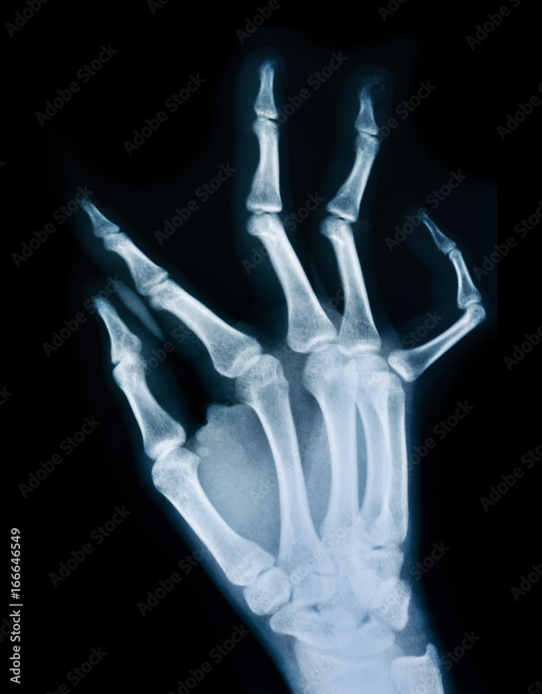 X ray of a hand. X ray of a hand.
