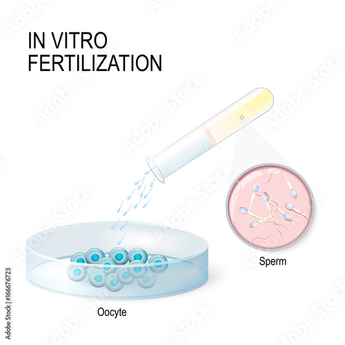 In vitro fertilization. artificial insemination