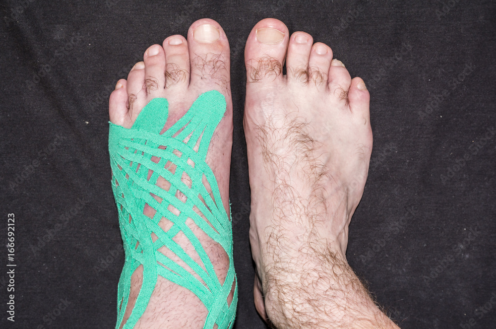Fototapeta premium Compare foot with taping slices and healthy.