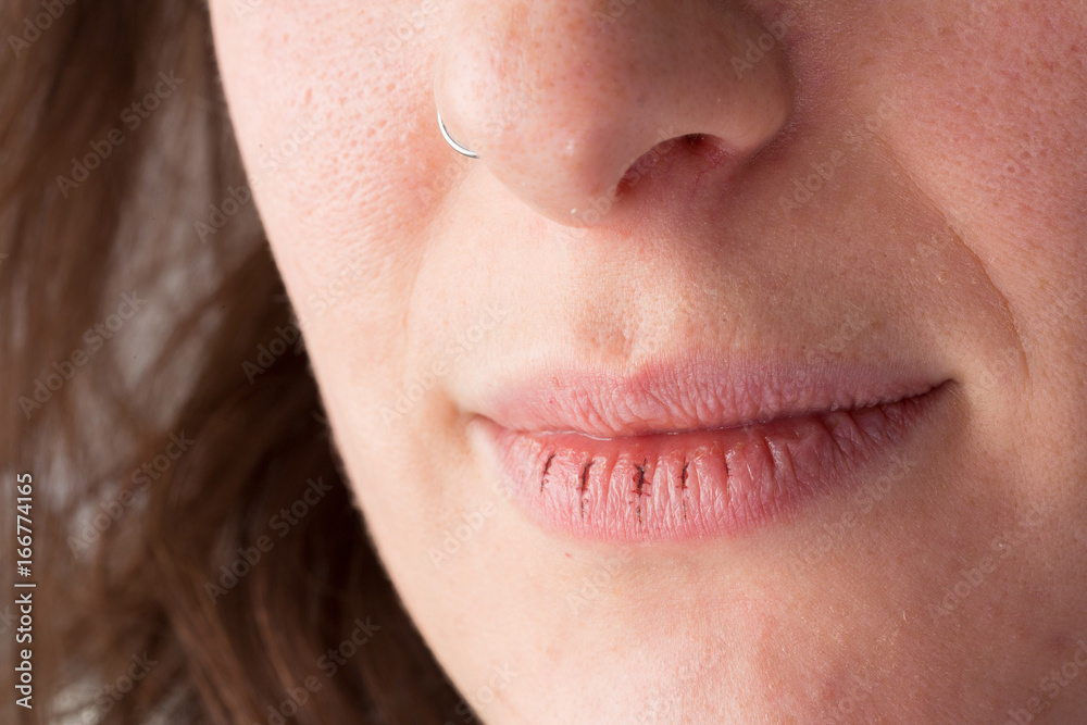 Fototapeta premium Female with chapped lips
