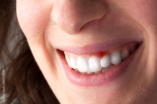 Smiling woman with red gingiva
