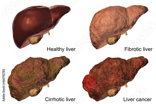 Liver disease progression in Hepatitis B and C viral infection, 3D illustration photo