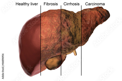 Liver disease progression in Hepatitis B and C viral infection, 3D illustration photo