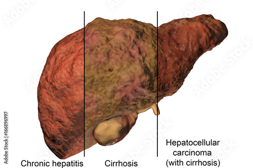 Liver disease progression in Hepatitis B and C viral infection, 3D illustration photo