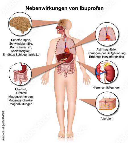 Nebenwirkungen von Ibuprofen