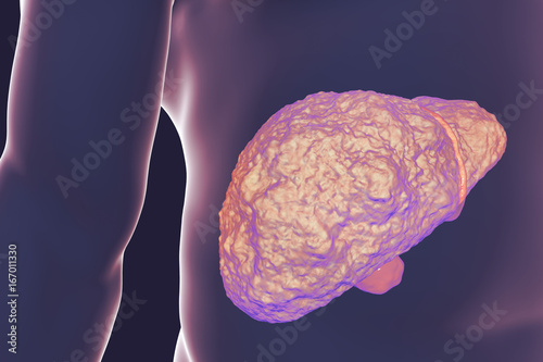 Liver with cirrhosis inside human body. 3D illustration photo