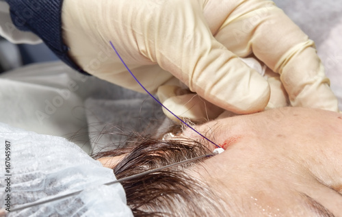 Dermatologist surgeon inserts polylactic acid filaments to perform facial lifting - Selective focus