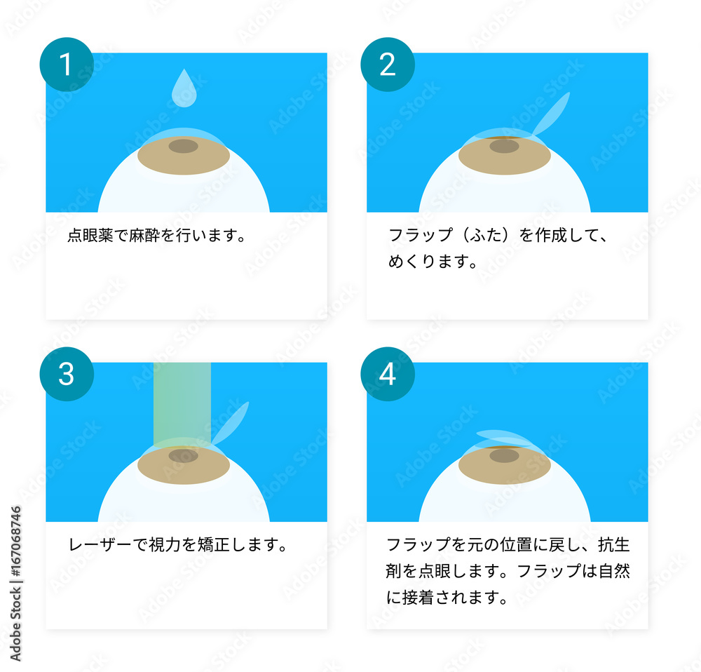 レーシック手術の図解ベクターイラスト Stock Vector Adobe Stock