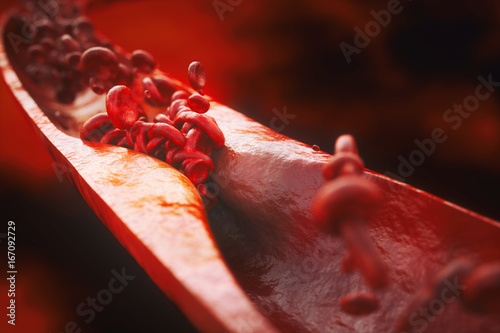 Closeup of a atherosclerosis- 3D rendering photo