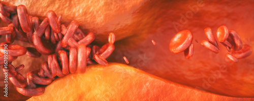 Konstfotografi Closeup of a atherosclerosis- 3D rendering