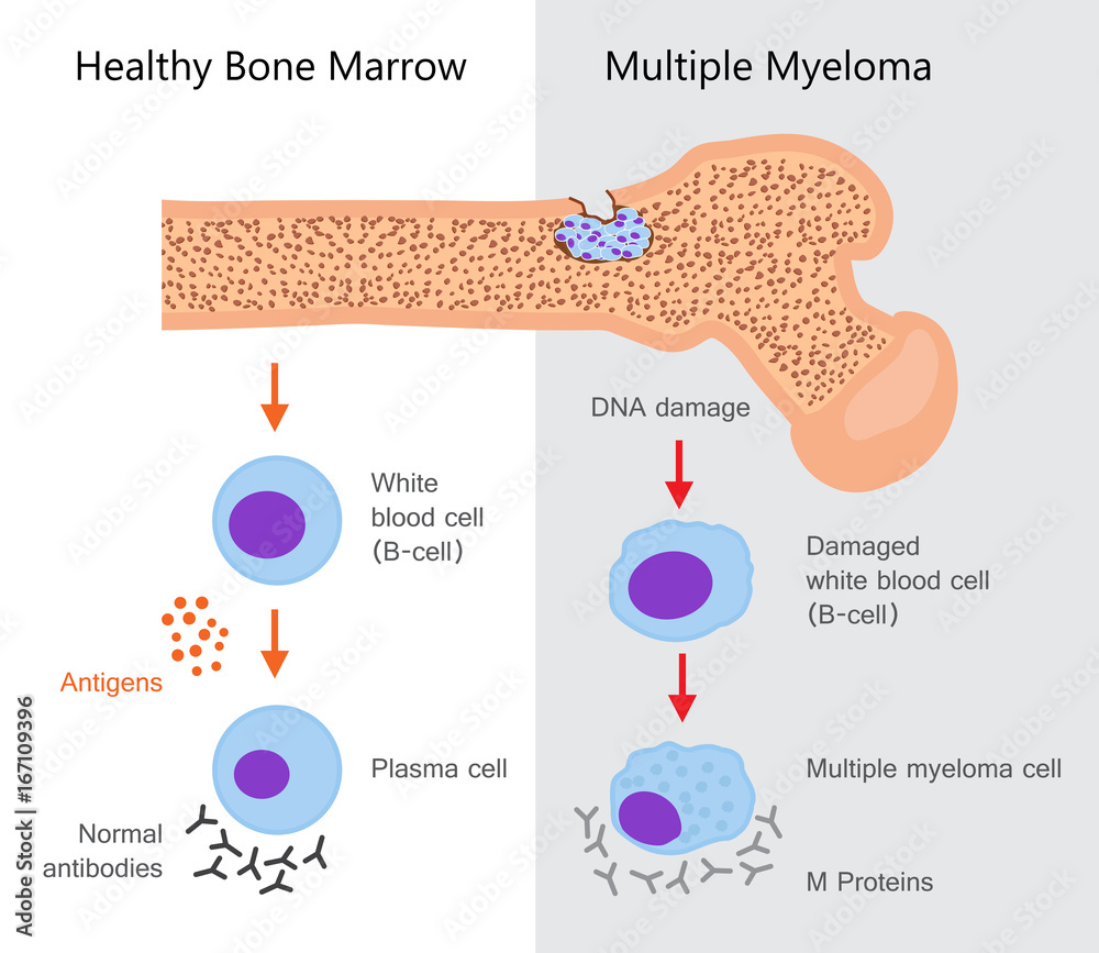 Multiple Myeloma Diagram Stock Vector Adobe Stock