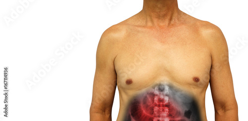 Obraz na plátně Colon cancer and Small intestine obstruction