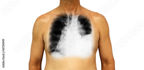 Lung cancer . Human chest and x-ray show pleural effusion left lung due to lung cancer photo