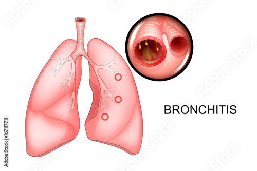 the lungs, affected with bronchitis photo