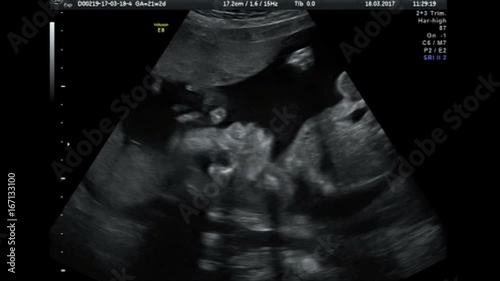 Ultrasound baby 22 weeks