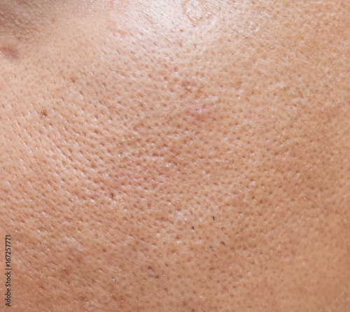 pores and oily on surface young asian man face skin do not take care for a long time