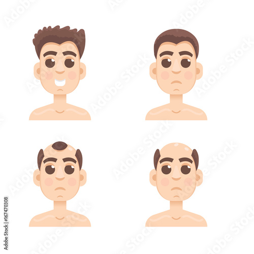 Hair stages loss. Types of baldness on male head vector.
