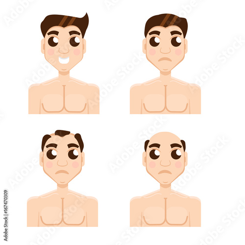 Hair stages loss. Types of baldness on male head vector.
