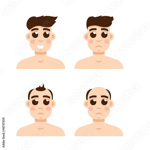 Hair stages loss. Types of baldness on male head vector.