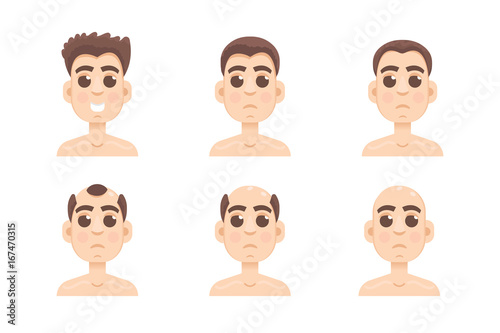 Hair stages loss. Types of baldness on male head vector.