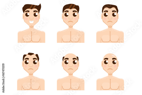 Hair stages loss. Types of baldness on male head vector.
