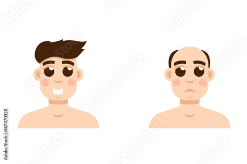 Hair stages loss. Types of baldness on male head vector.
