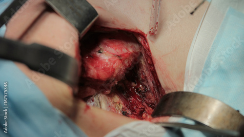 Hip joint replacement surgery macro after hip removed